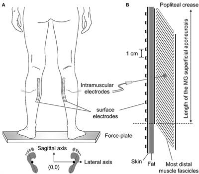 Postural Muscle Unit Plasticity in Stroke Survivors: Altered Distribution of Gastrocnemius' Action Potentials